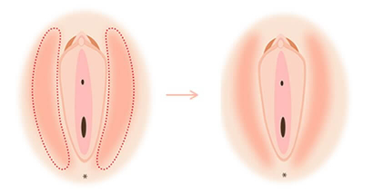 ⼤陰唇縮⼩