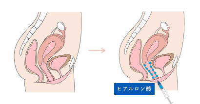 膣縮⼩